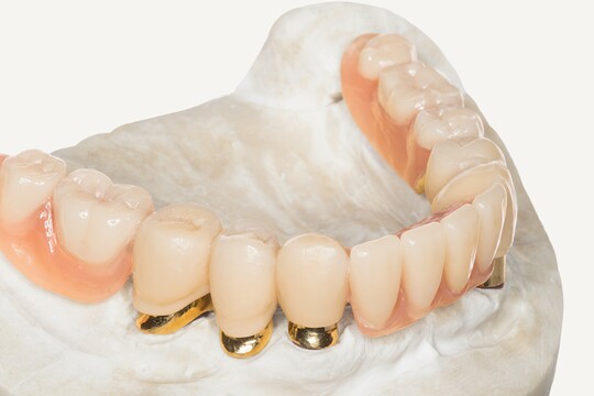 Nahaufnahme eines zahntechnischen Modells, das eine Teilprothese oder Teleskopkrone auf einem Gipsstumpf zeigt. Die Arbeit besteht aus weißen Zähnen mit goldfarbenen Metallunterkonstruktionen und einem rosafarbenen Zahnfleischanteil.
