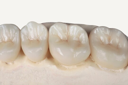 Nahaufnahme von vier fertigen, hochglänzenden Zahnkronen oder Brückengliedern in natürlicher Farbe, die auf einem Gipsmodell eines Kiefers sitzen.