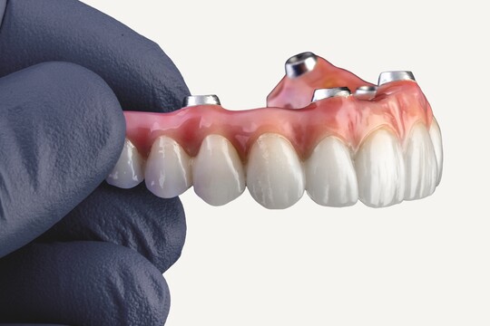 Nahaufnahme einer Hand in einem schwarzen Schutzhandschuh, die eine festsitzende, implantatgetragene Prothese hält. Die Prothese besteht aus rosafarbenem Zahnfleischersatz, weißen Zähnen und freiliegenden Abutments.